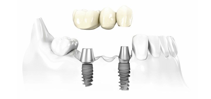 Discounts on implants in the clinic of aesthetic medicine «Ex Tempore»